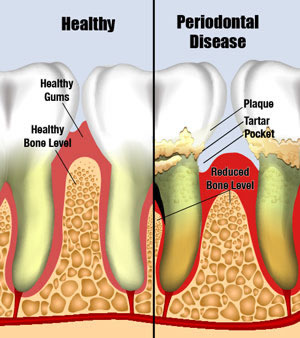 Periodontal-Disease.jpg