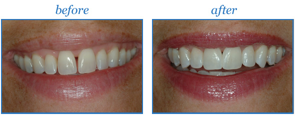 before-after-composite-fillings.jpg