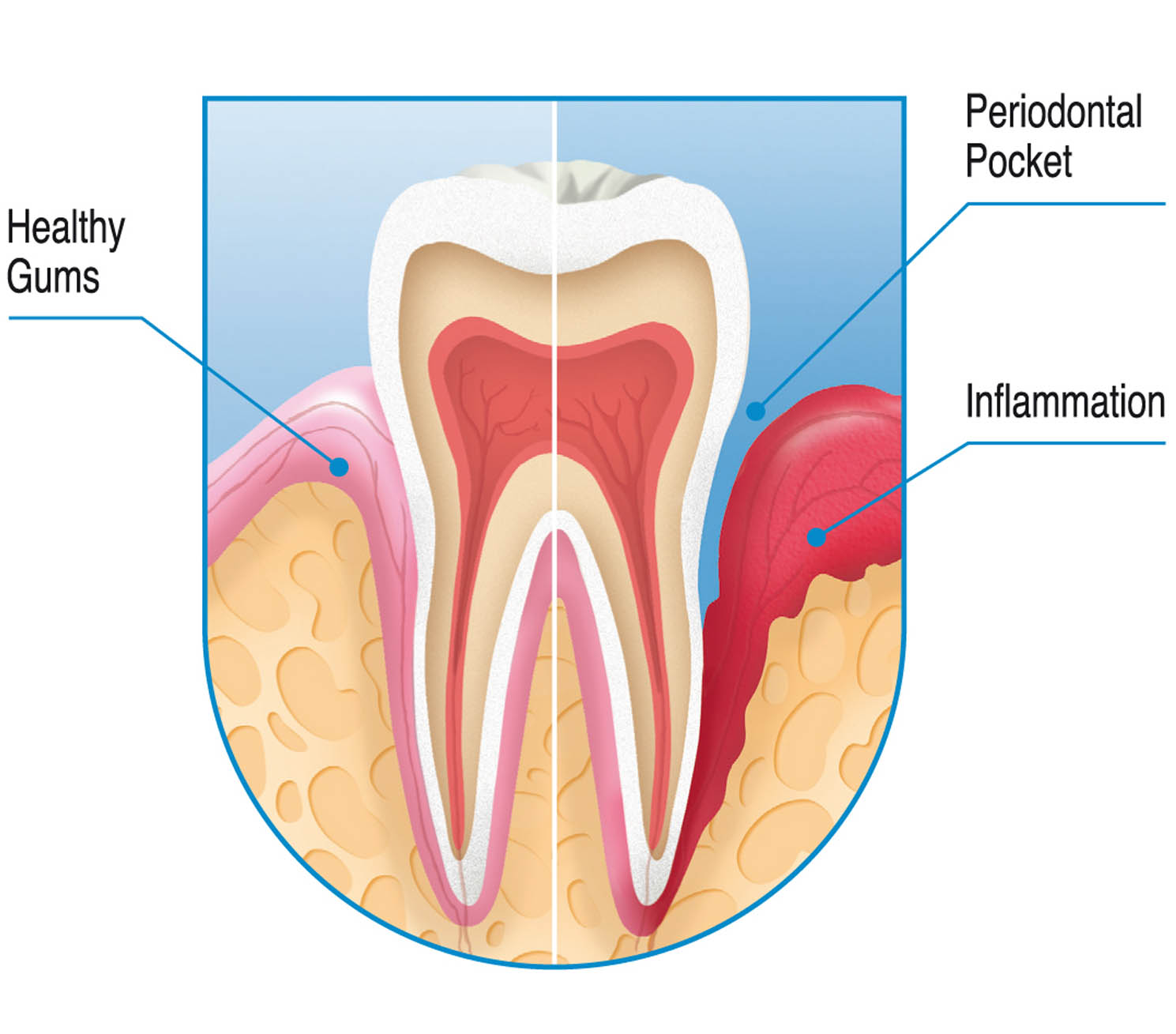gum-disease1.jpg
